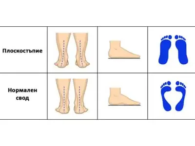Chart: a flat foot and a normal arch, seen from behind, from the side and as a footprint